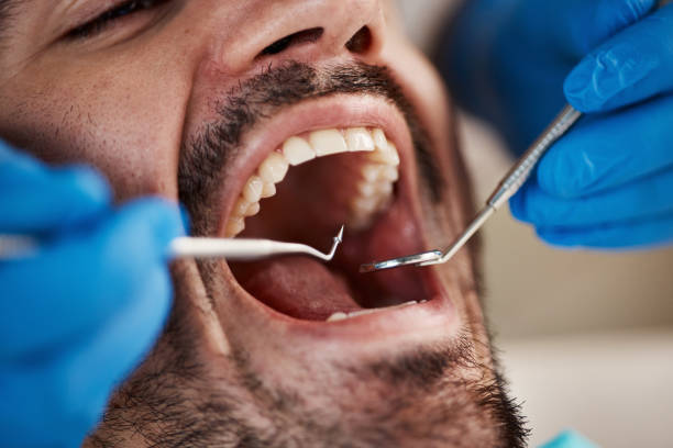 Best Broken or Cracked Tooth Emergency Dentist in Heber, UT